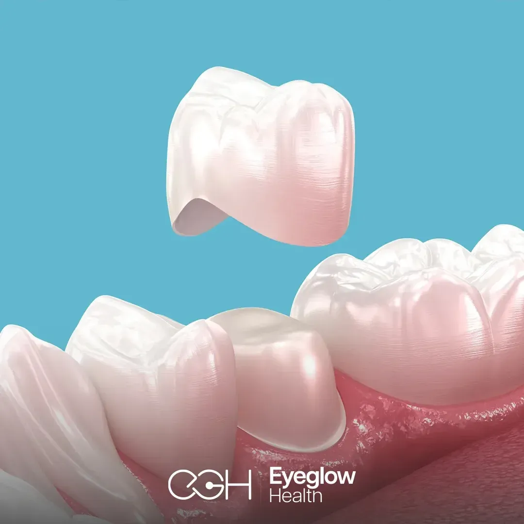 E-Max crown at Eyeglow, Istanbul
