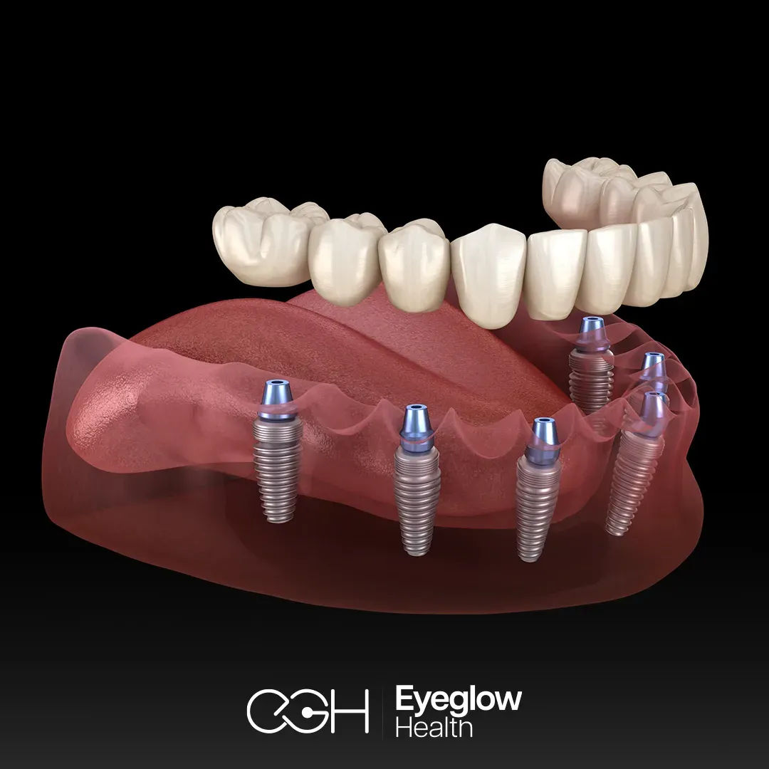 All-on-6 implants at Eyeglow, Istanbul