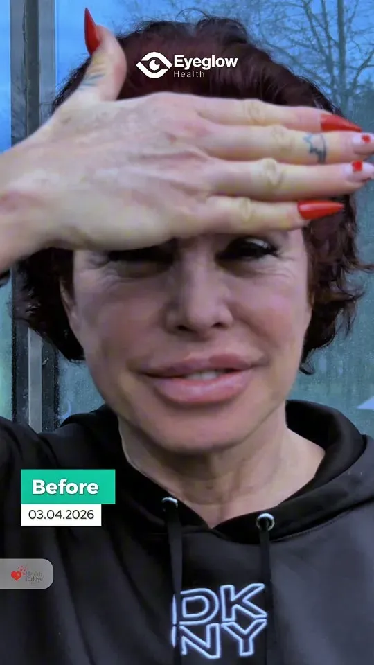 Silvia Cristina Guidi De Knappe — Keratopigmentation testimonial