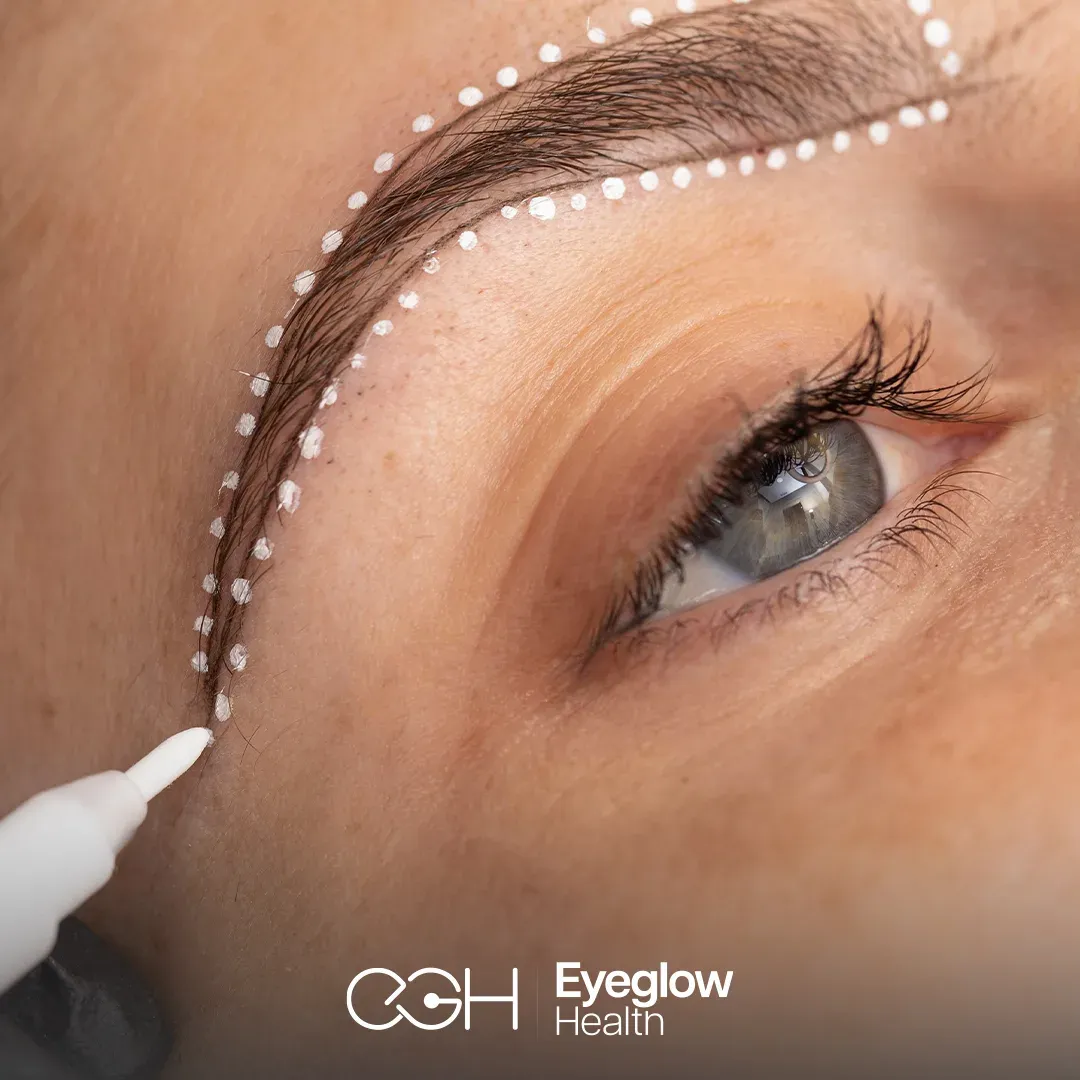 Eyebrow transplant at Eyeglow, Istanbul