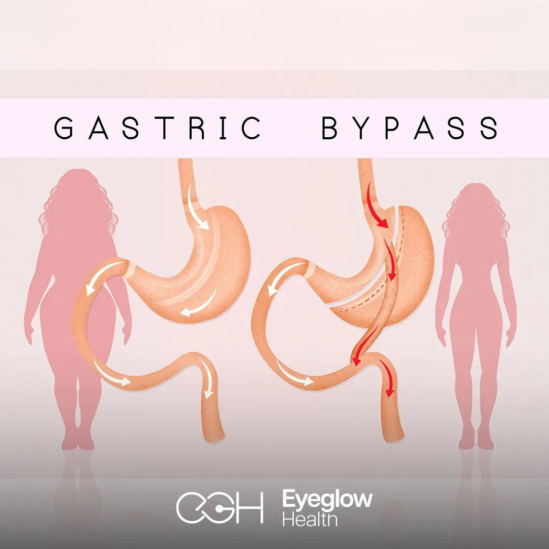 Gastric bypass surgery at Eyeglow, Istanbul