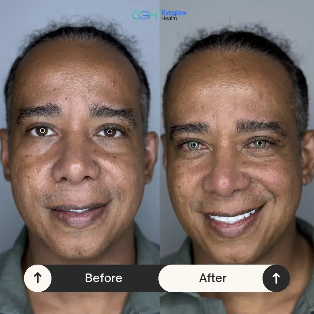 Patientenfall einer Keratopigmentation bei Eyeglow Health, Istanbul — Vorher-Nachher-Vergleich: dunkelbraune Iris beider Augen in einen Grünton verändert