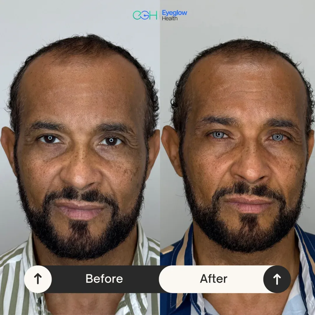 Patientenfall einer Keratopigmentation bei Eyeglow Health, Istanbul — Vorher-Nachher-Vergleich: dunkelbraune Iris beider Augen in einen graublauen Ton verändert