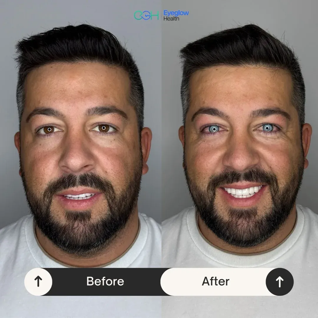 Patientenfall einer Keratopigmentation bei Eyeglow Health, Istanbul — Vorher-Nachher-Vergleich: dunkelbraune Iris beider Augen in einen hellblauen Ton verändert