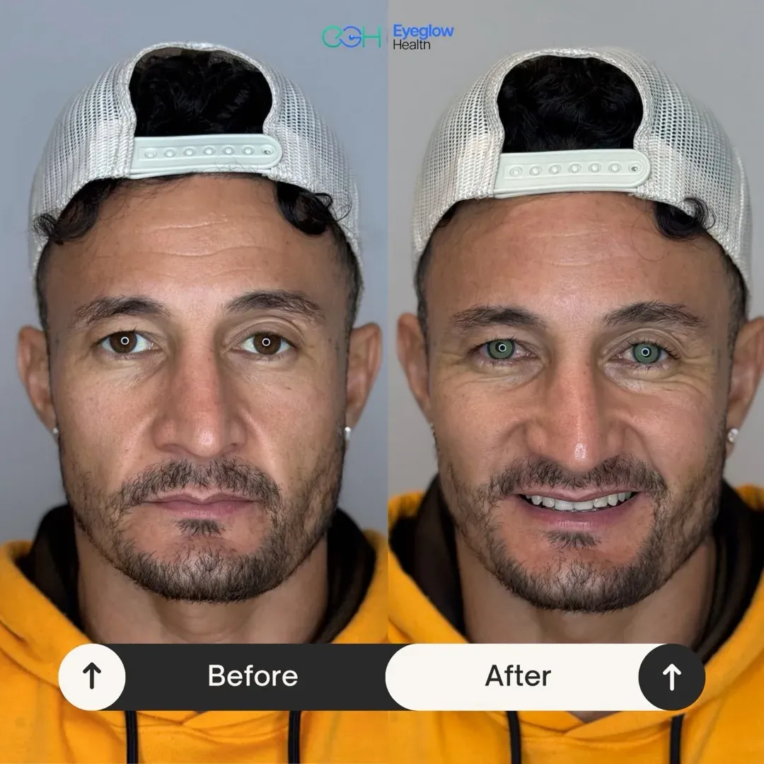 Patientenfall einer Keratopigmentation bei Eyeglow Health, Istanbul — Vorher-Nachher-Vergleich: braune Iris beider Augen in einen graugrünen Ton verändert