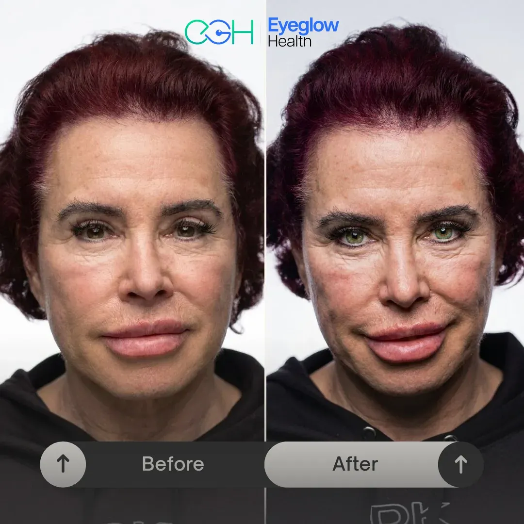 Patient before and after keratopigmentation eye colour change at Eyeglow Health, Istanbul